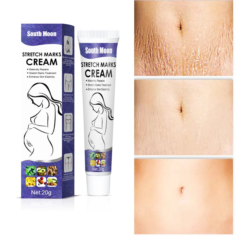 South Moon 20gNourishing Skin For Stretch Mark And Acne Scar Removal For Body