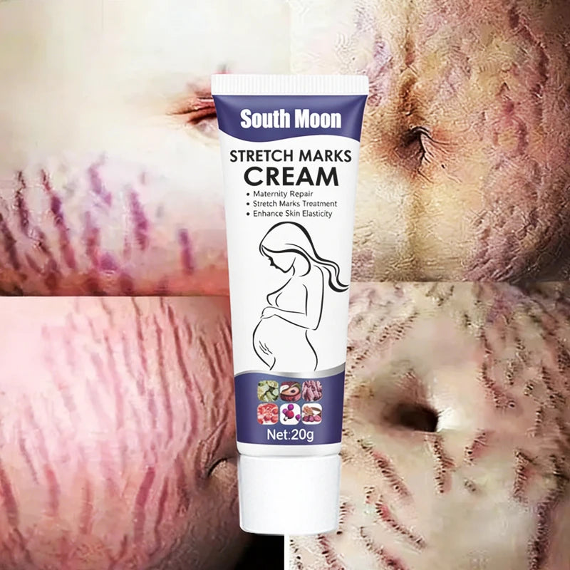 South Moon 20gNourishing Skin For Stretch Mark And Acne Scar Removal For Body