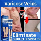 Varicose Vein Treatment for Legs | Spider Vein and Varicose Vein Cream | Collagen Protein