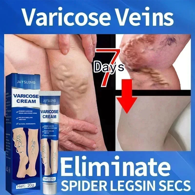 Varicose Vein Treatment for Legs | Spider Vein and Varicose Vein Cream | Collagen Protein